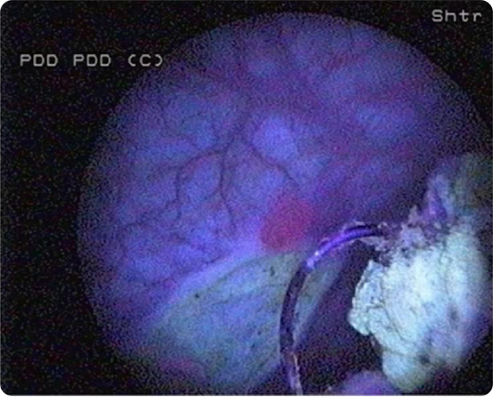 resection management