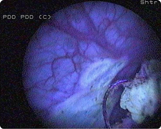 resection management 2